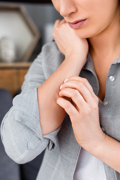 cropped view of allergic woman scratching hand