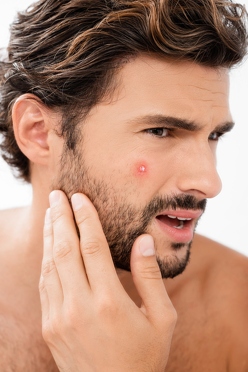 Confused man touching cheek with acne isolated on grey