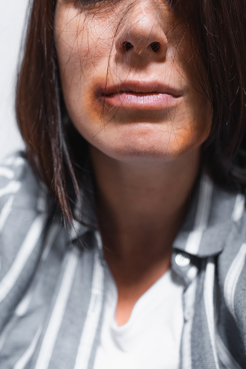 Cropped view of bruises on face of victim of domestic violence