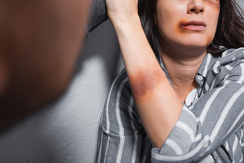 Cropped view of victim of domestic violence with bruises near husband on blurred foreground
