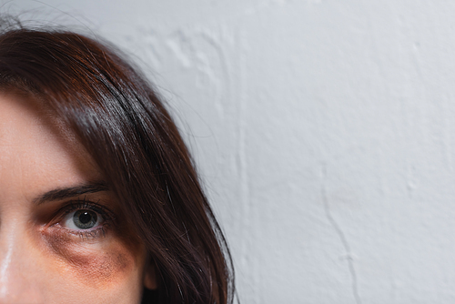 Cropped view of woman with bruise around eye 