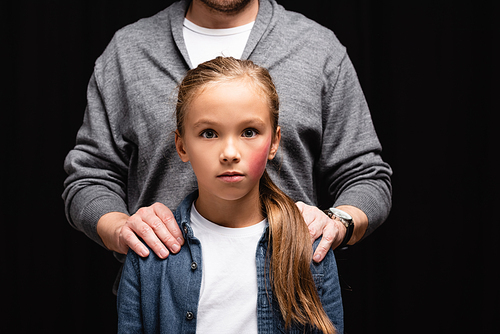 Father embracing child with bruise on cheek isolated on black