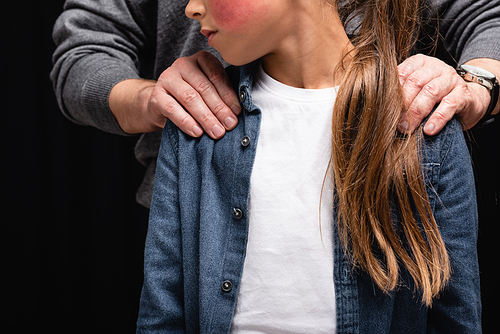 Cropped view of father embracing daughter with bruise isolated on black