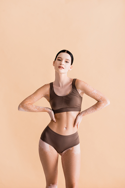 young beautiful woman with vitiligo posing in underwear isolated on beige