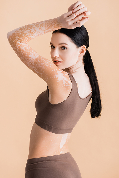 young beautiful woman with vitiligo posing in underwear isolated on beige