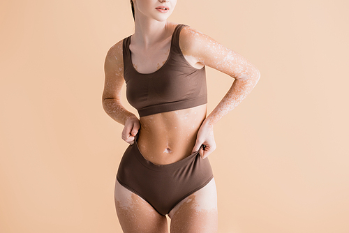 cropped view of young beautiful woman with vitiligo posing in underwear isolated on beige