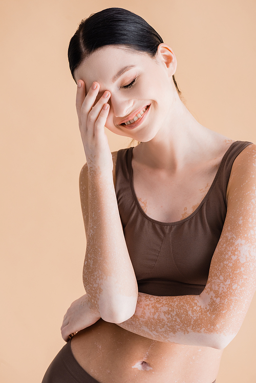 smiling young beautiful woman with vitiligo posing in underwear isolated on beige