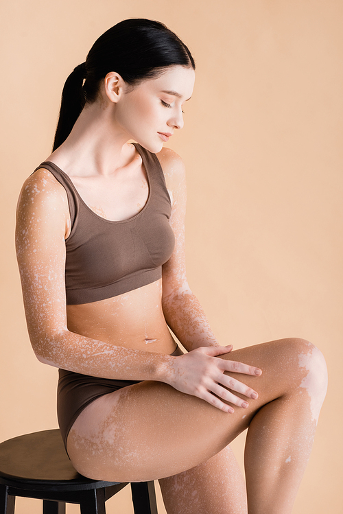 young beautiful woman with vitiligo posing on chair isolated on beige