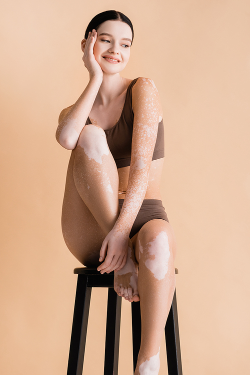 smiling young beautiful woman with vitiligo posing on chair isolated on beige