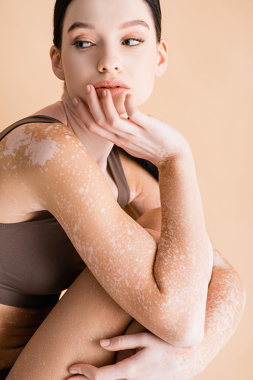 young beautiful woman with vitiligo isolated on beige