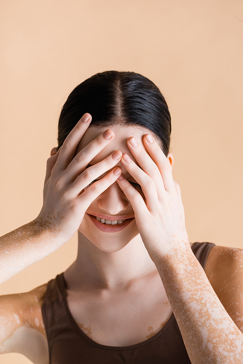 smiling young beautiful woman with vitiligo covering eyes isolated on beige