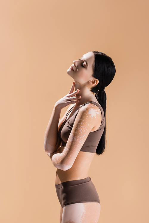 side view of young beautiful woman with vitiligo posing isolated on beige
