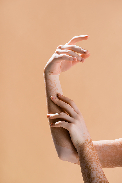 cropped view of female hands with vitiligo isolated on beige