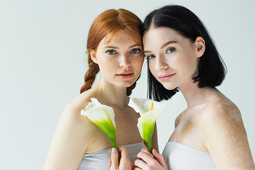 Body positive women with freckles and vitiligo holding flowers isolated on grey