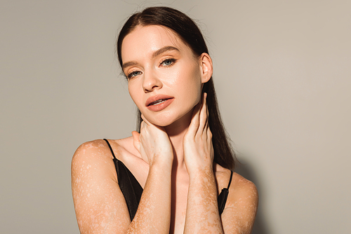 Portrait of pretty woman with vitiligo looking at camera on grey background