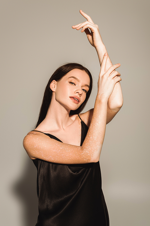 Stylish young woman with vitiligo touching arm and looking at camera on grey background