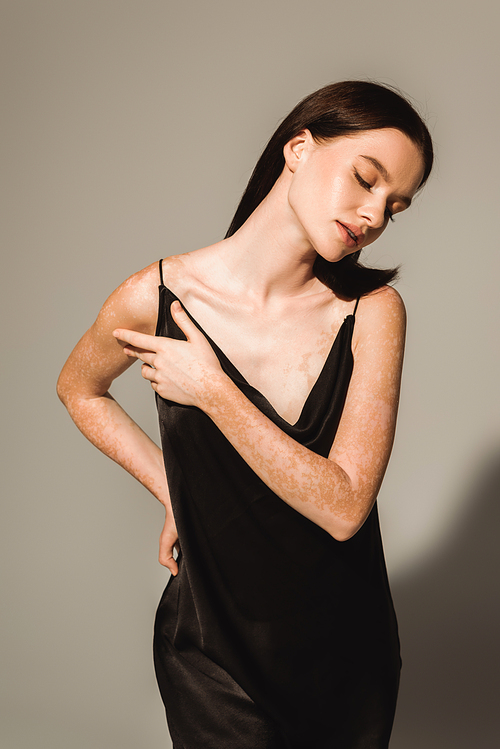 Pretty young woman with vitiligo touching black silk dress on grey background