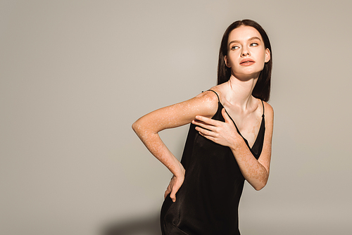 Trendy woman with vitiligo posing with hand on hip in satin dress on grey background