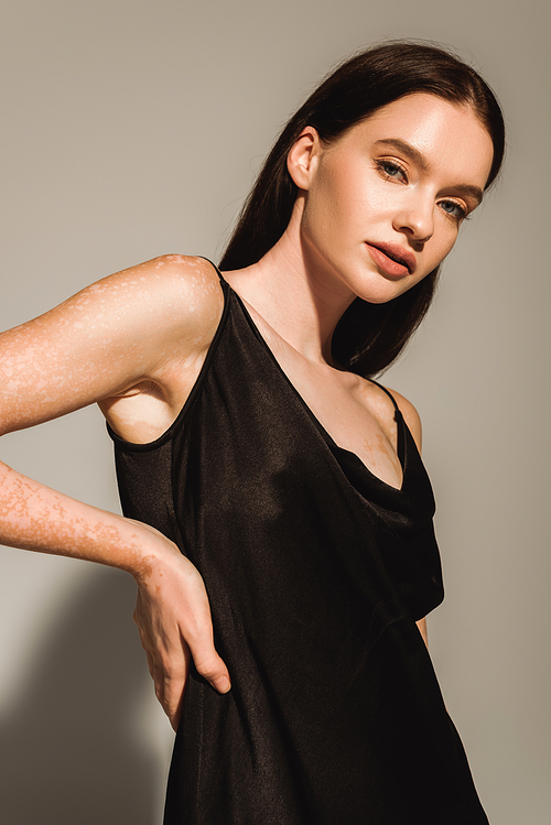 Fashionable young woman with vitiligo posing in silk dress on grey