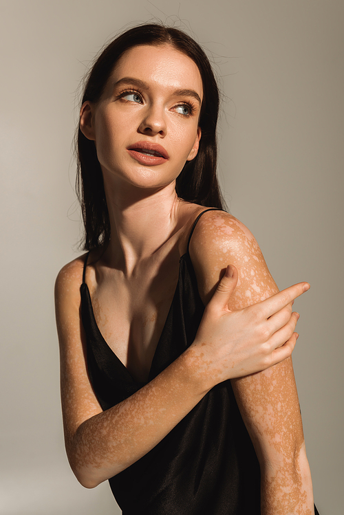 Portrait of pretty woman with vitiligo touching shoulder isolated on grey with light