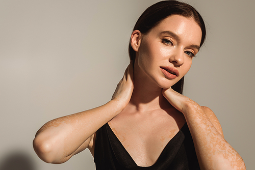 Pretty young model with vitiligo touching neck and looking at camera on grey background