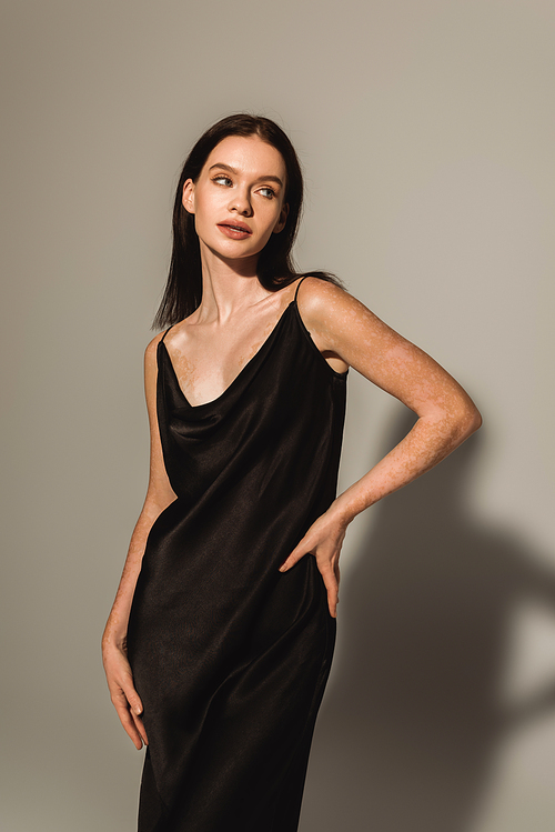 Stylish model with vitiligo in black silk dress standing with hand on hip on grey background