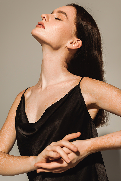 Pretty model with vitiligo posing in silk dress on grey background