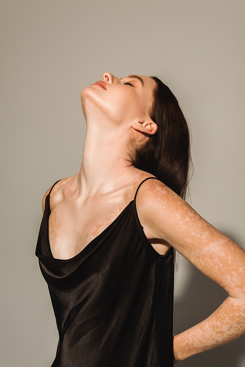 Young model with vitiligo posing in black camisole on grey background