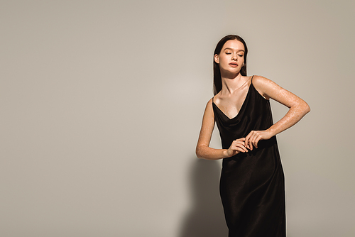 Trendy woman with vitiligo posing in black camisole on grey background