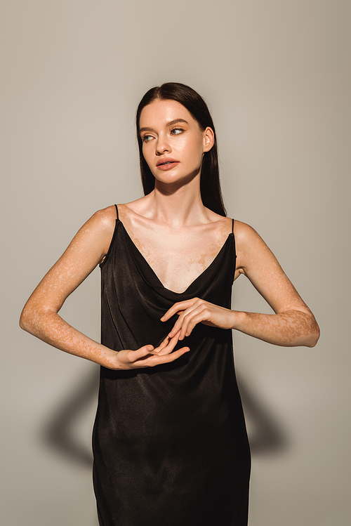 Stylish model with vitiligo posing in black dress and touching hands on grey background with shadow