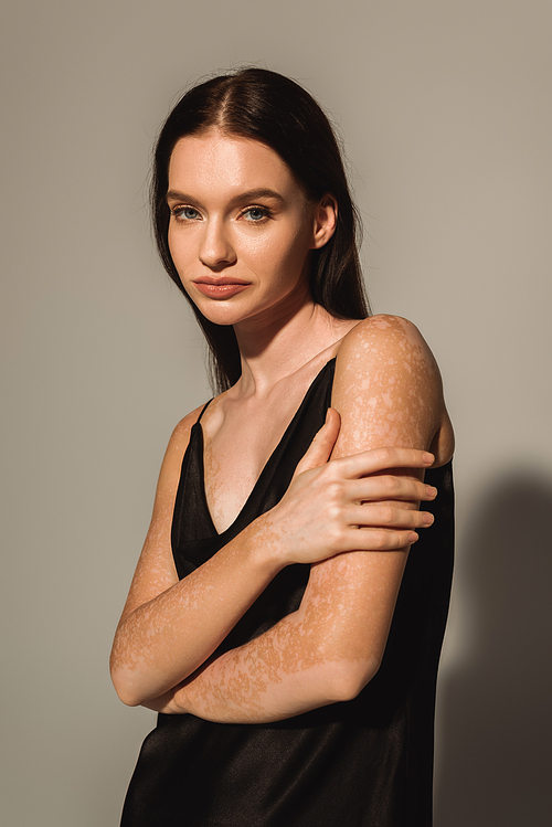 Portrait of brunette model with vitiligo in satin dress looking at camera on grey background