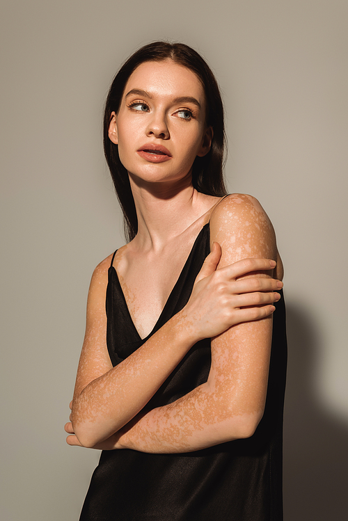 Pretty woman with vitiligo posing in satin dress and looking away on grey background