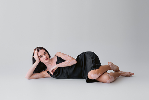 Pretty and barefoot woman with vitiligo lying on grey background