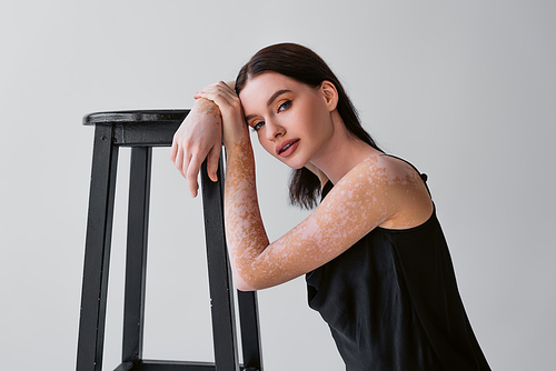 Pretty brunette woman with vitiligo posing near chair isolated on grey