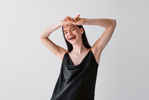 Cheerful woman with vitiligo closing eyes while posing isolated on grey