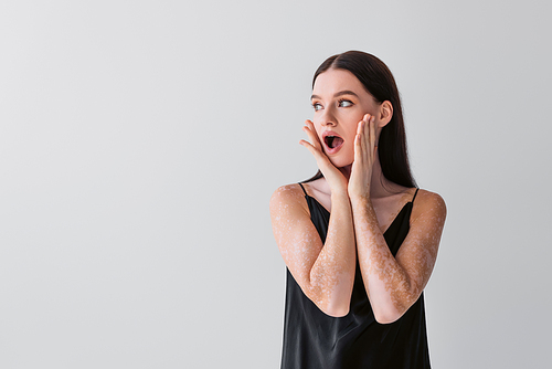 Shocked woman with vitiligo touching cheeks and looking away isolated on grey