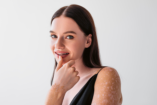 Portrait of pretty woman with vitiligo touching lip and smiling at camera isolated on grey