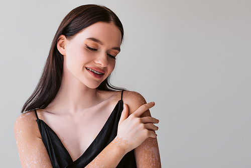 Pretty young woman with vitiligo and braces touching shoulder and smiling isolated on grey