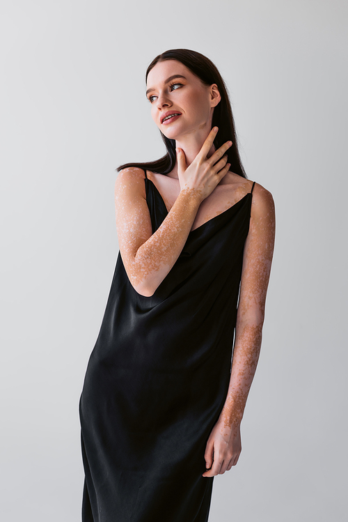 Positive model with vitiligo touching neck while posing in dress isolated on grey