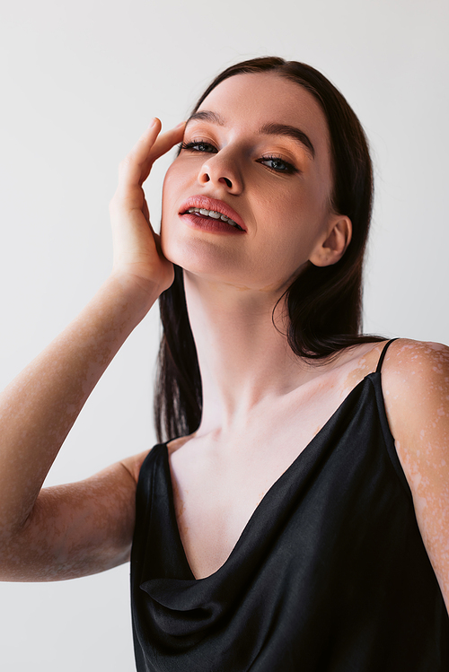 Portrait of pretty brunette woman with vitiligo touching face isolated on grey