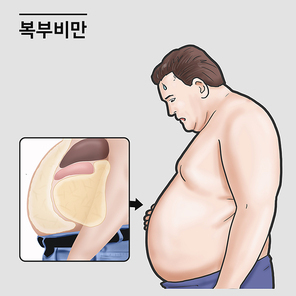 복부비만 남성