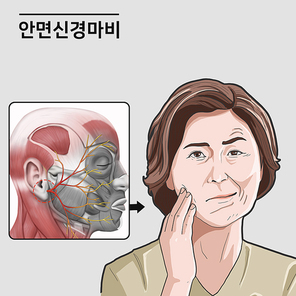 안면신경마비 여성