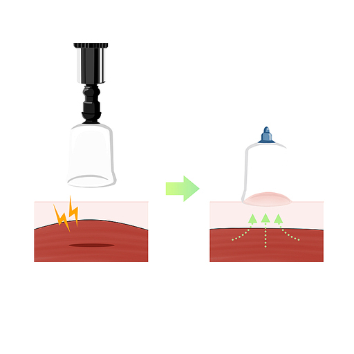 부항 근육피로회복 한의학치료 효과 일러스트