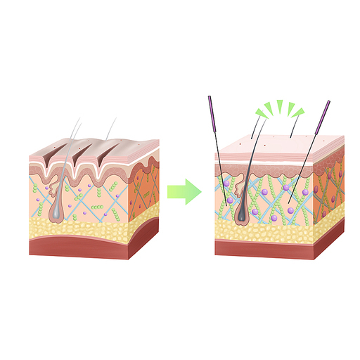 정안침 피부미용 한의학치료 효과 일러스트