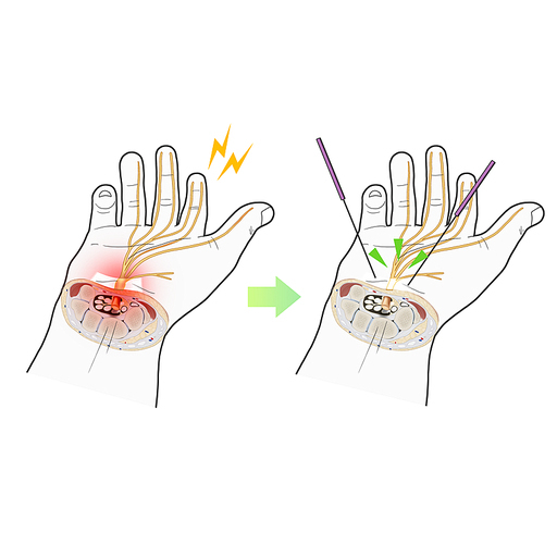 손목터널증후군 침치료 한의학치료 효과 일러스트