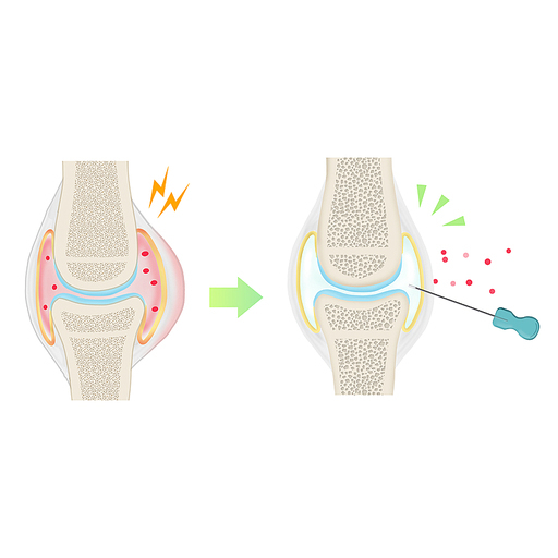 도침 관절염 한의학치료 효과 일러스트
