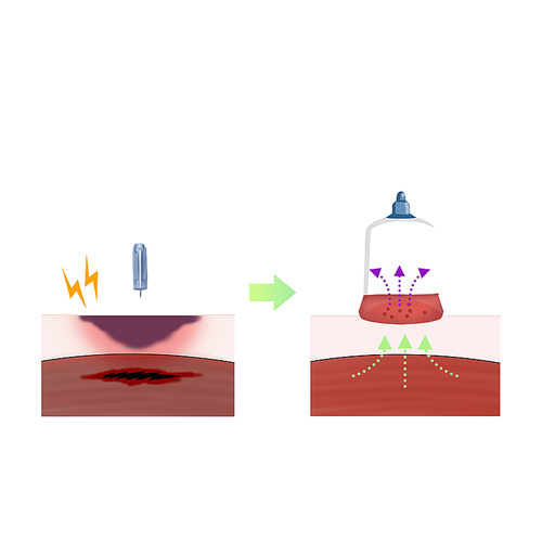 부항 사혈 타박상 한의학치료 효과 일러스트