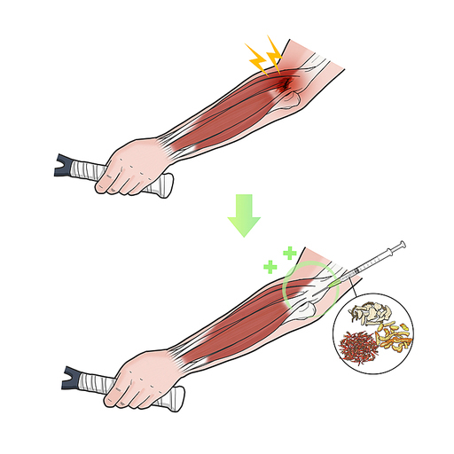 약침 테니스엘보 염증 한의학치료 효과 일러스트