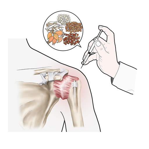 약침 오십견 한의학치료 효과 일러스트