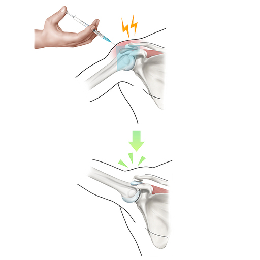 어깨충돌증후군 약침 봉침 한의학 치료 효과 기전 설명 일러스트